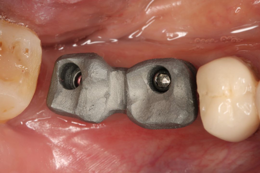 Máster Implantes Dentales y Rehabilitación