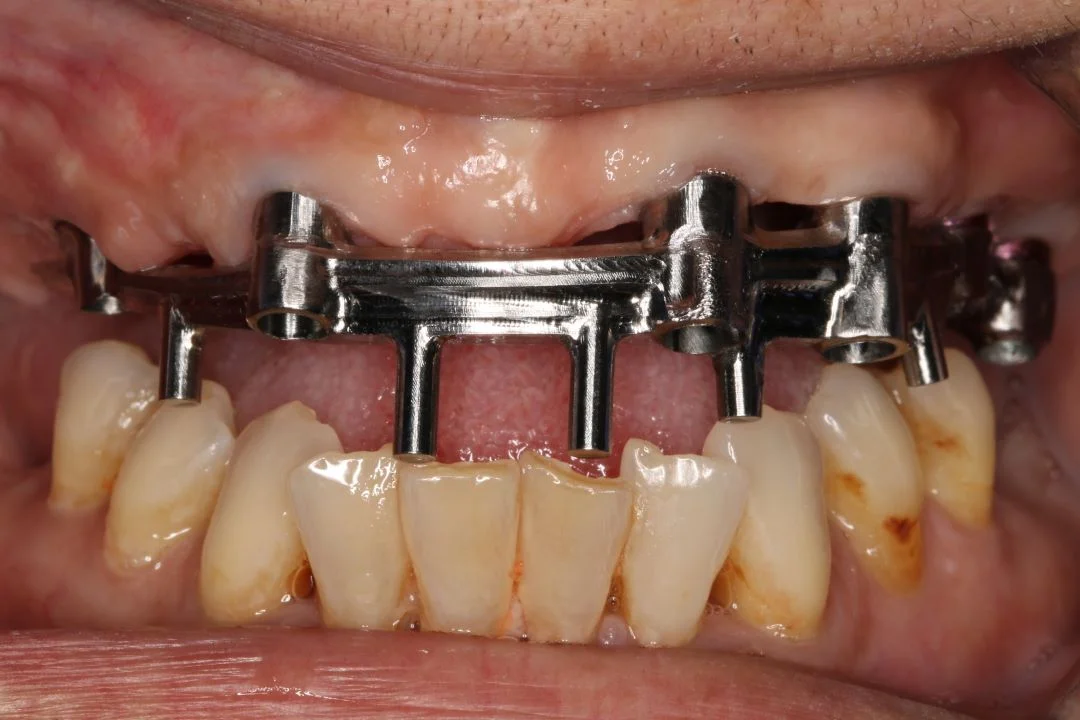 Máster Implantes Dentales y Rehabilitación