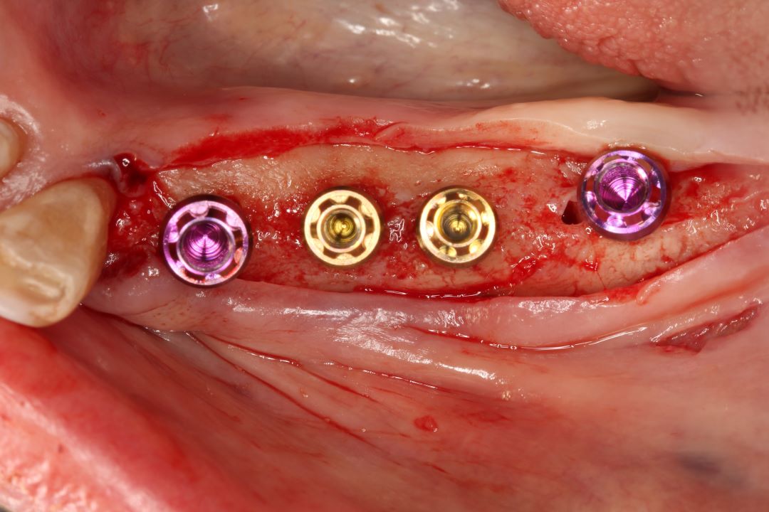 Máster Implantes Dentales y Rehabilitación