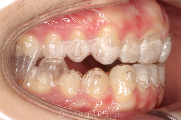 Avance mandibular ortodoncia