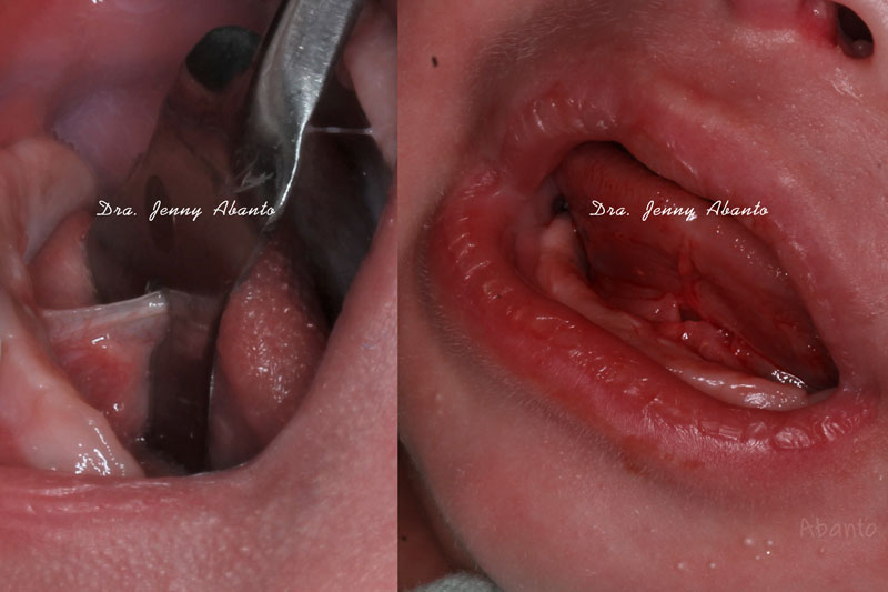 Anquiloglosia Master Odontopediatria