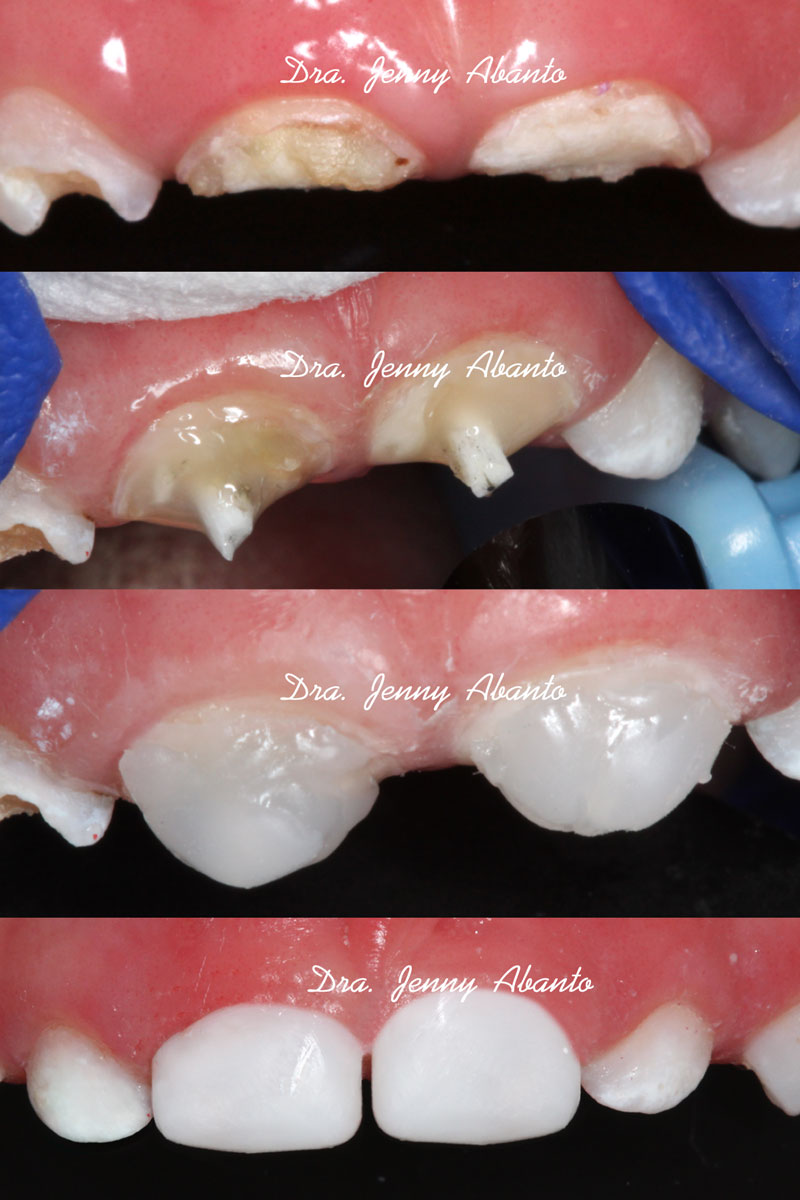 Rehabilitación Anterior Master Odontopediatría