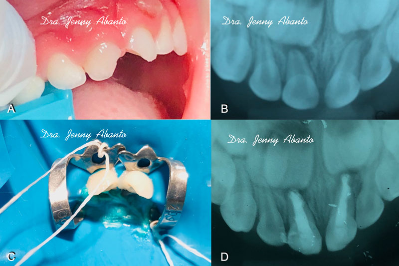 Trauma Endodoncia Master Odontopediatria