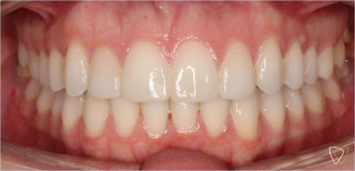 Antes y Despues Ortodoncia Invisalign